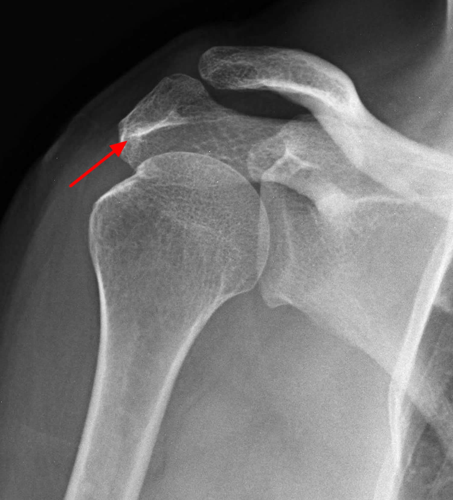 shoulder bone spur