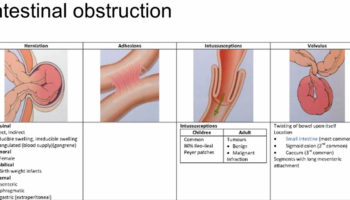 bowel obstruction
