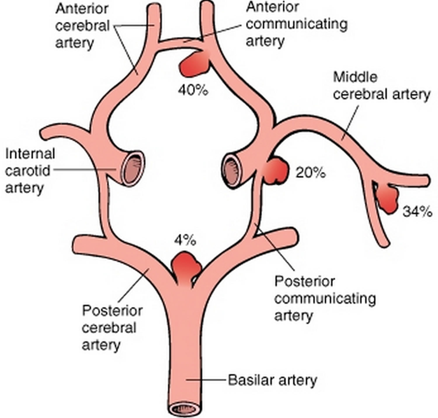 Brain Aneurysm Circle Of Willis 