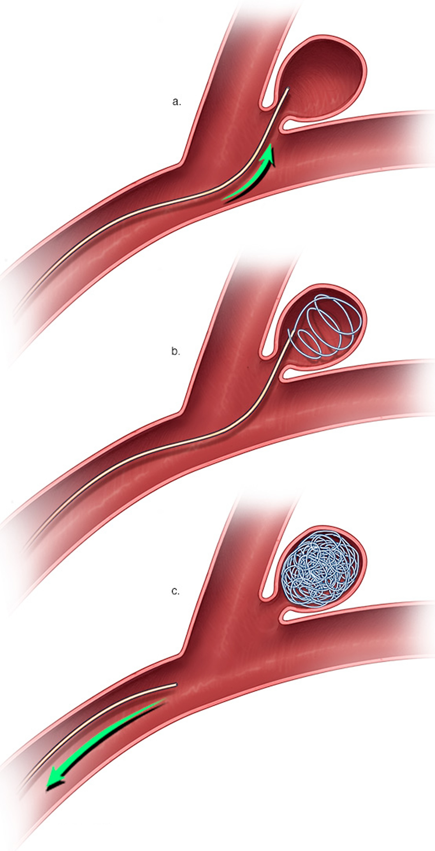 Brain Aneurysm - Causes, Symptoms, Warning Signs, Treatment