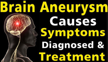 brain aneurysm