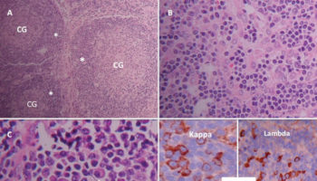 castleman disease