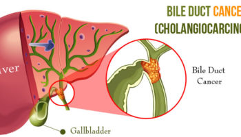 cholangiocarcinoma