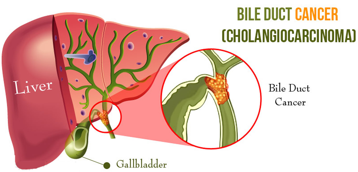 Hormone Therapy for Bile Duct Cancer - Rijal's Blog