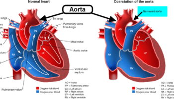 coarctation of aorta