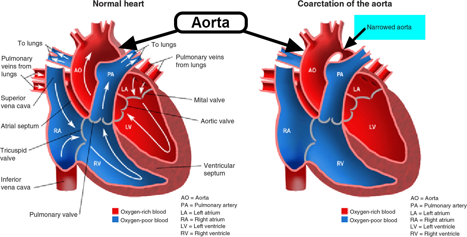 Coarctation Of Aorta In Infants Symptoms Murmur Surgery