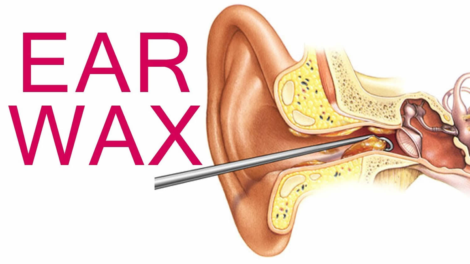 cleaning out impacted ear wax