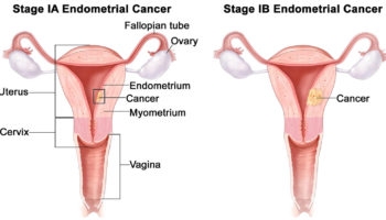endometrial cancer