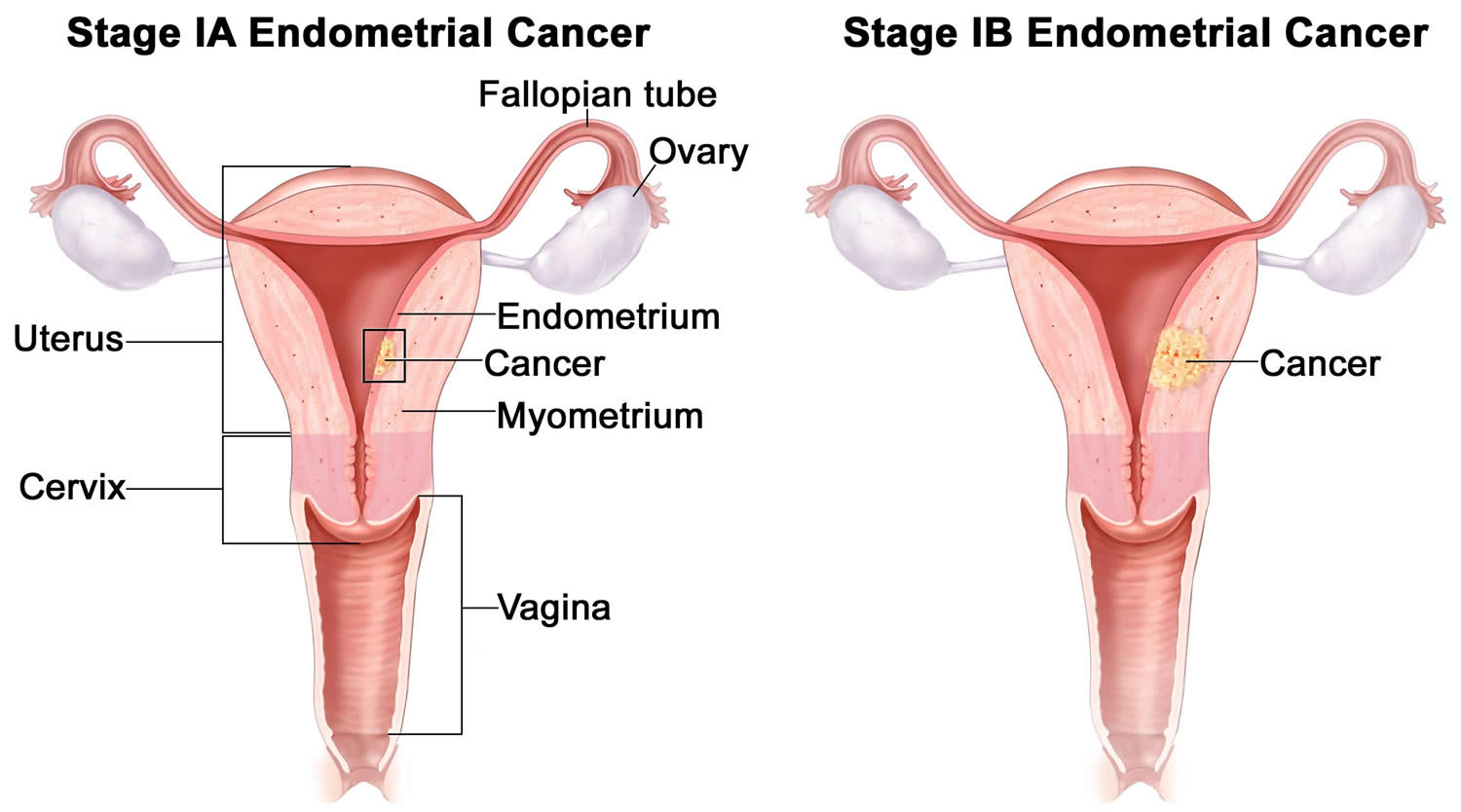 Endometrial Cancer - Causes, Early Signs, Symptoms, Treatment