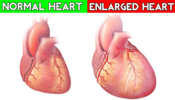 enlarged heart