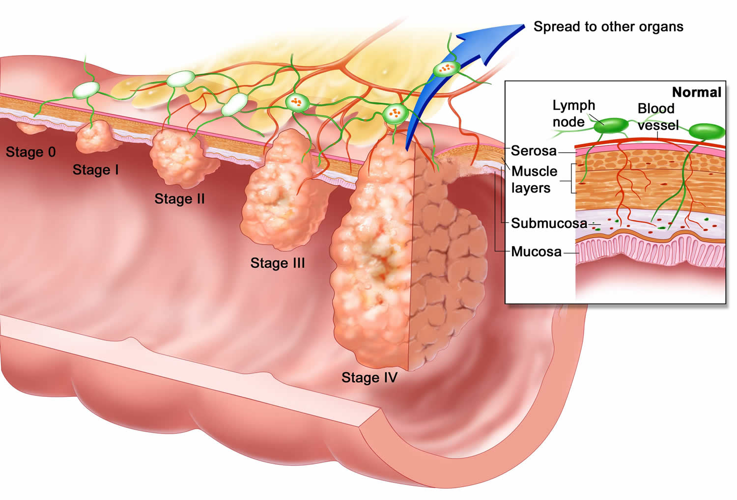 What Are Survival Rates For Esophageal Cancer