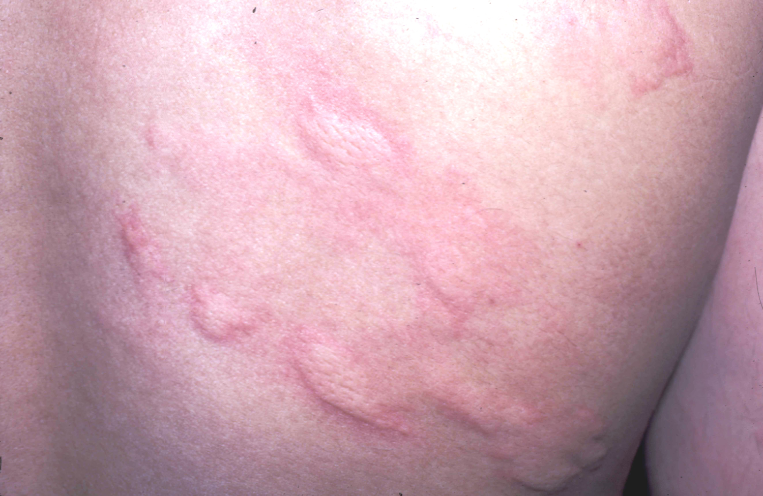 food allergy rash