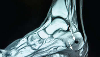 foot osteomyelitis – mri scan