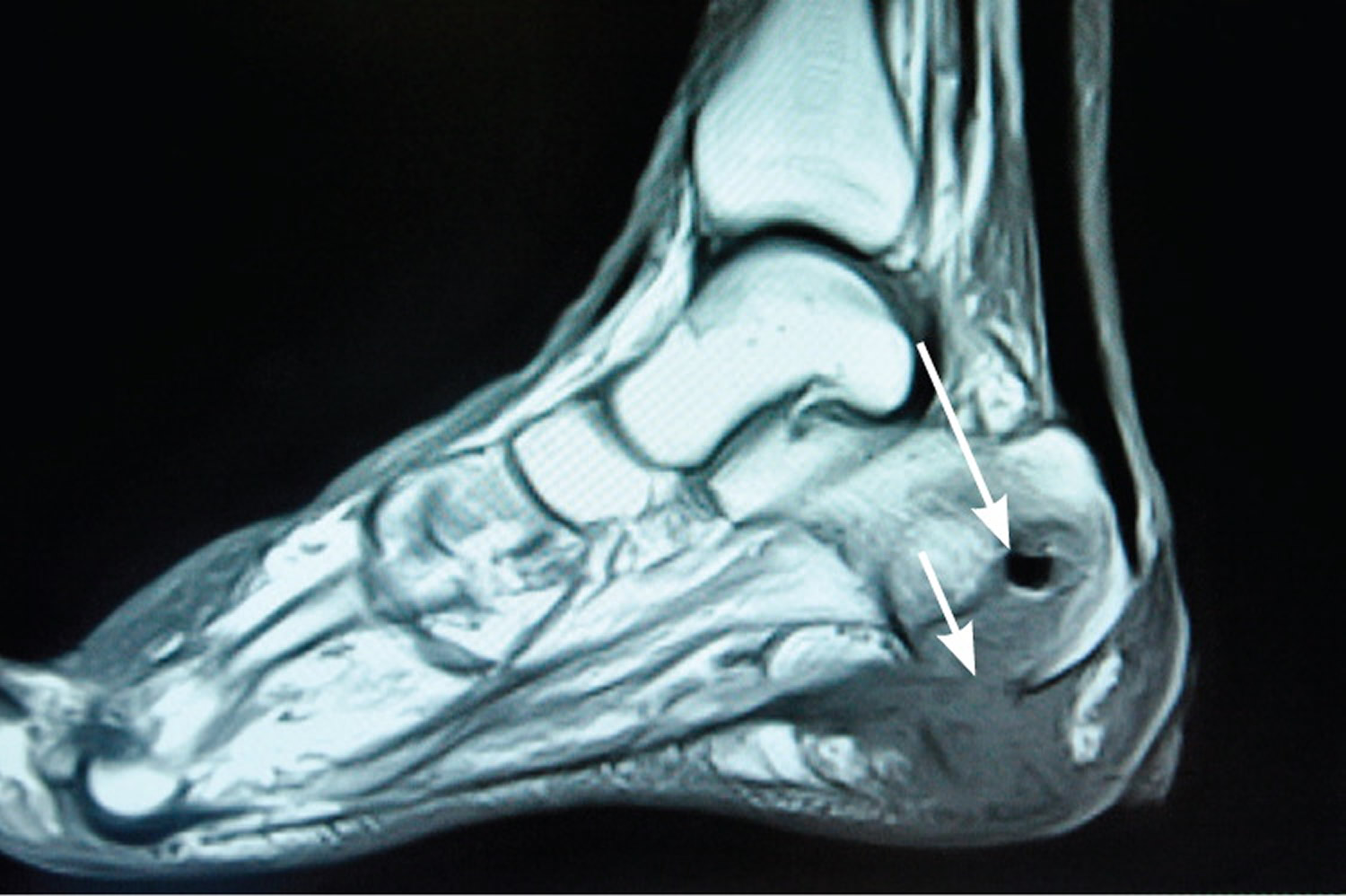 Osteomyelitis Acute Chronic Osteomyelitis Symptoms Treatment