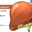 gallbladder cancer