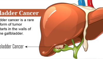 gallbladder cancer