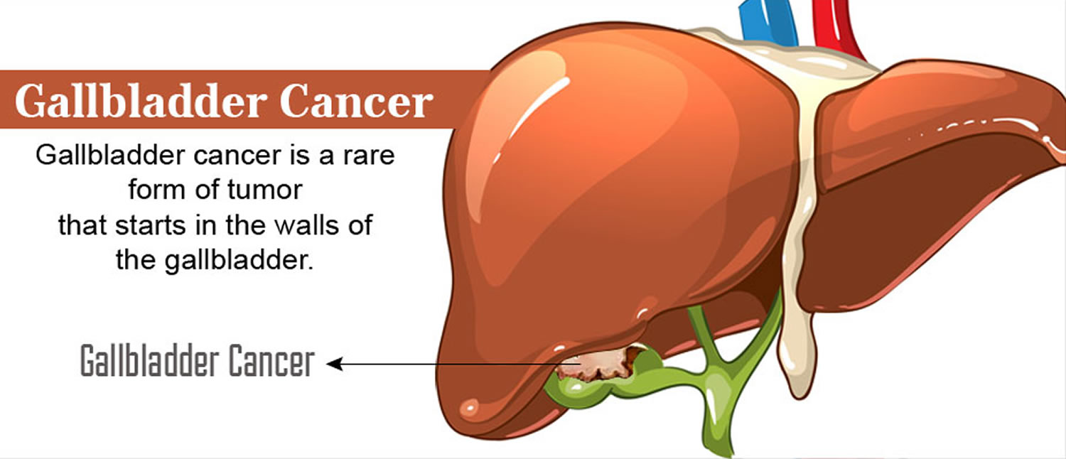 Gallbladder Cancer - Causes, Signs, Symptoms, Treatment