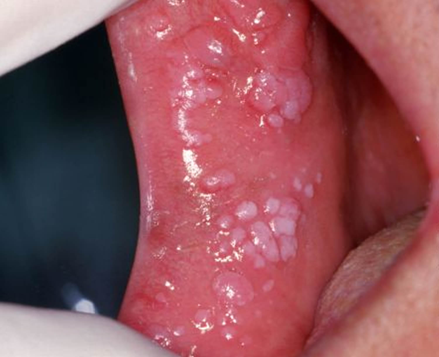 Genital Warts Around The Mouth