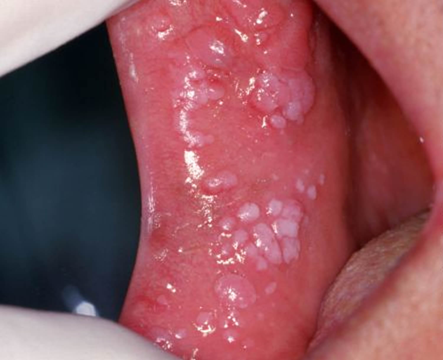 genital warts usmle step 2 mynotes