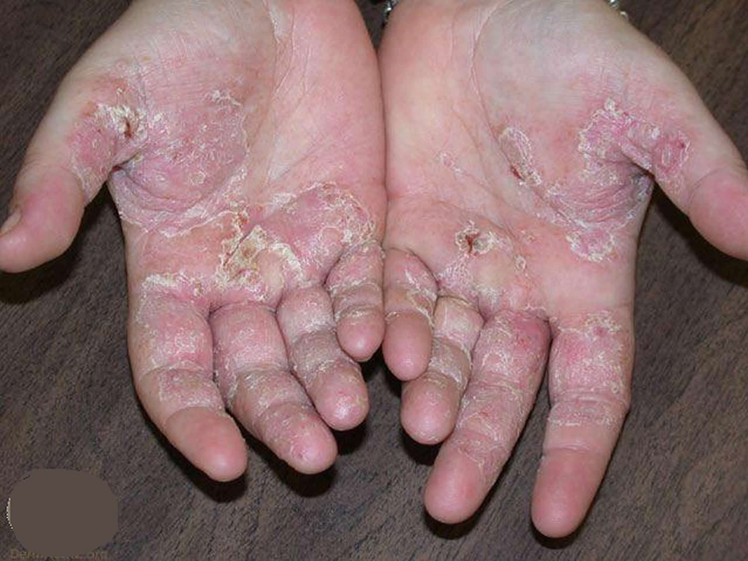 Hand Eczema 1 
