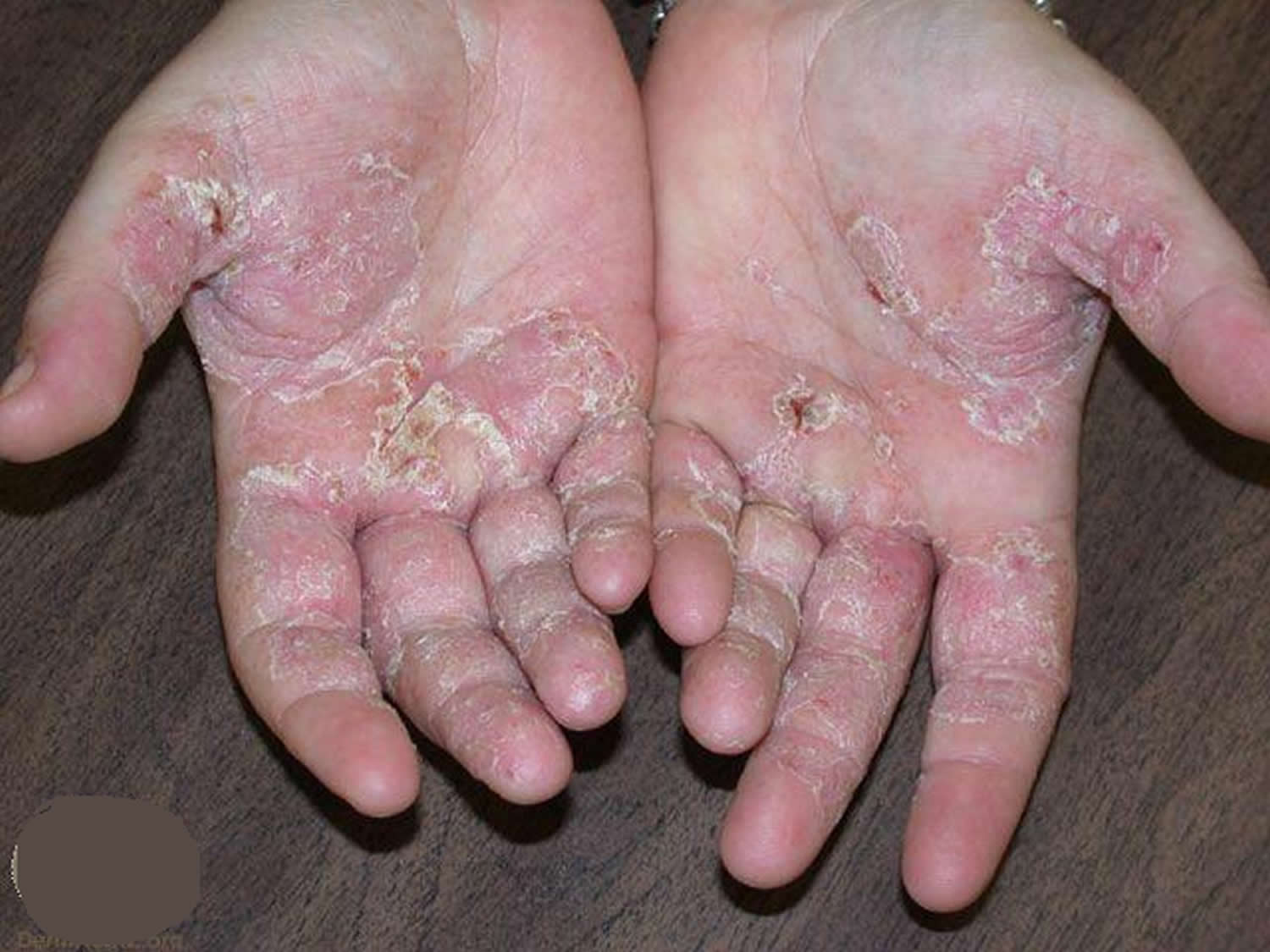 Eczema Hand Face Baby Causes Symptoms Treatment   Hand Eczema 1 