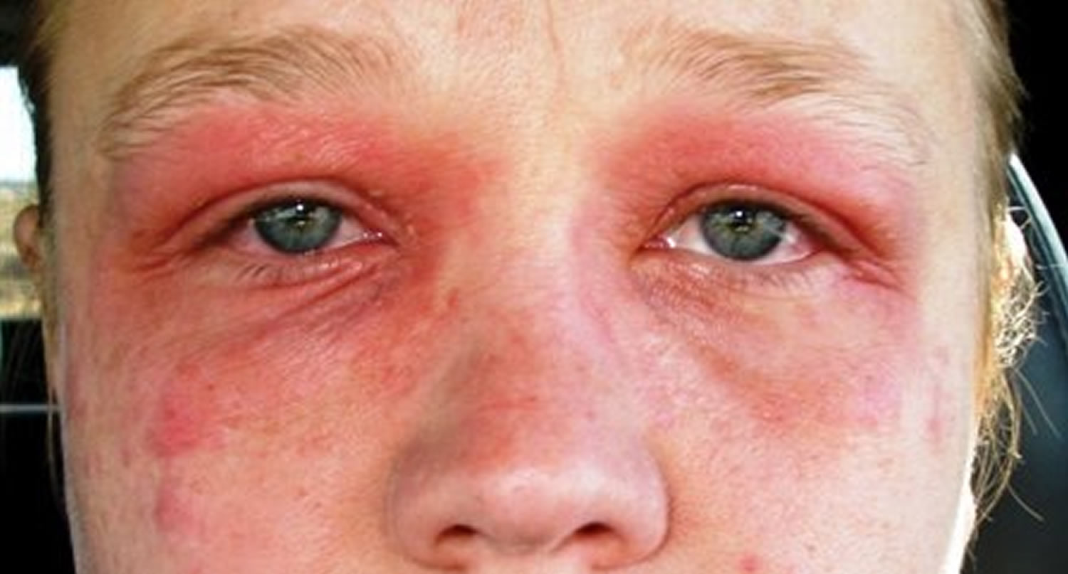 hay-fever-causes-hay-fever-symptoms-rash-medication-treatment