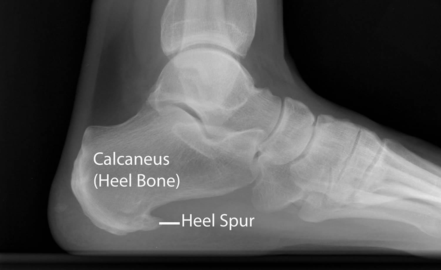Bone spurs - Symptoms and causes - Mayo Clinic