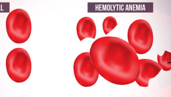 hemolytic anemia