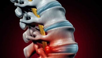 herniated disk
