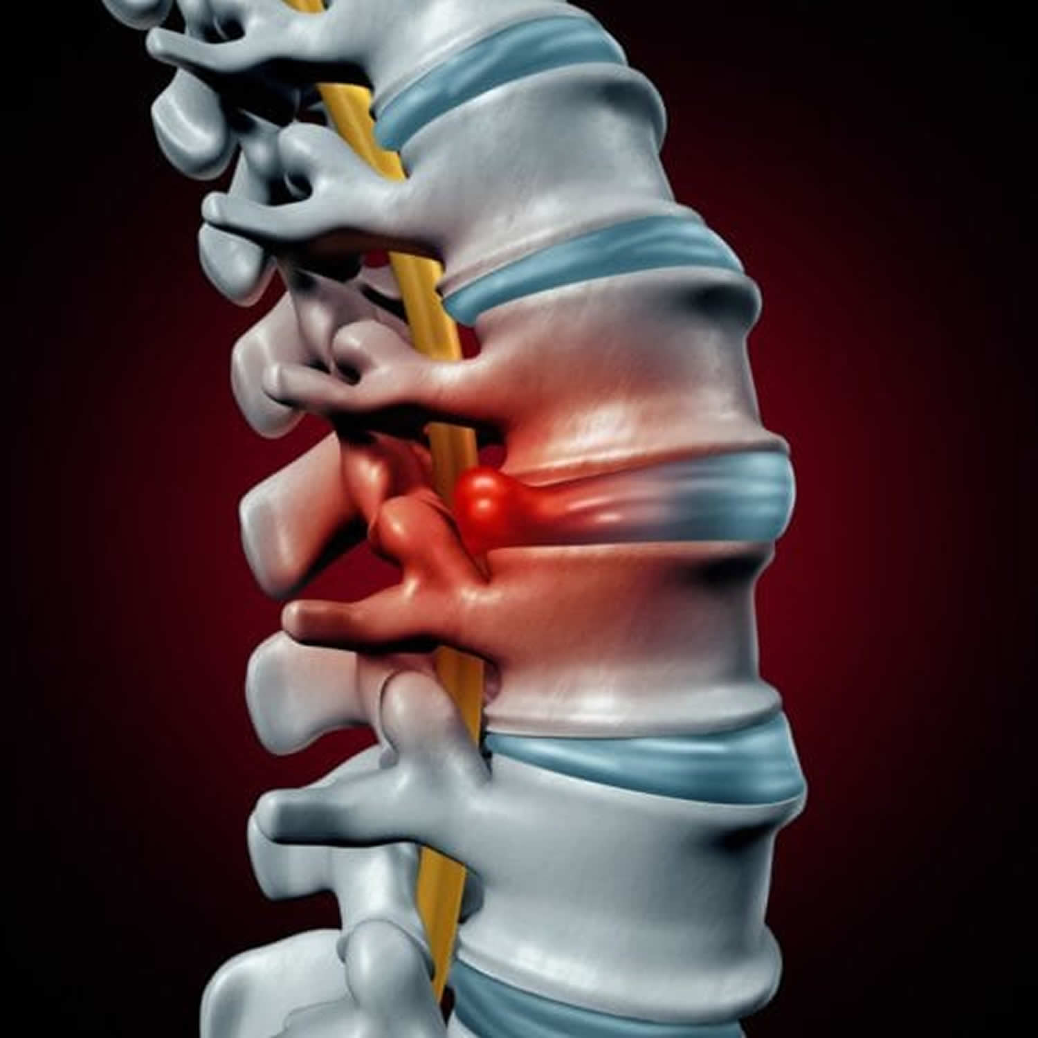 xray lumbar spine bulging disk