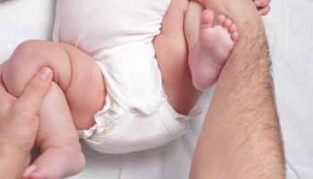 hip dysplasia
