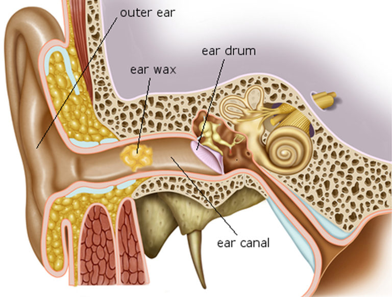 Ear Wax Blockage - Causes, Symptoms, How to Remove Ear Wax