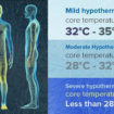 hypothermia