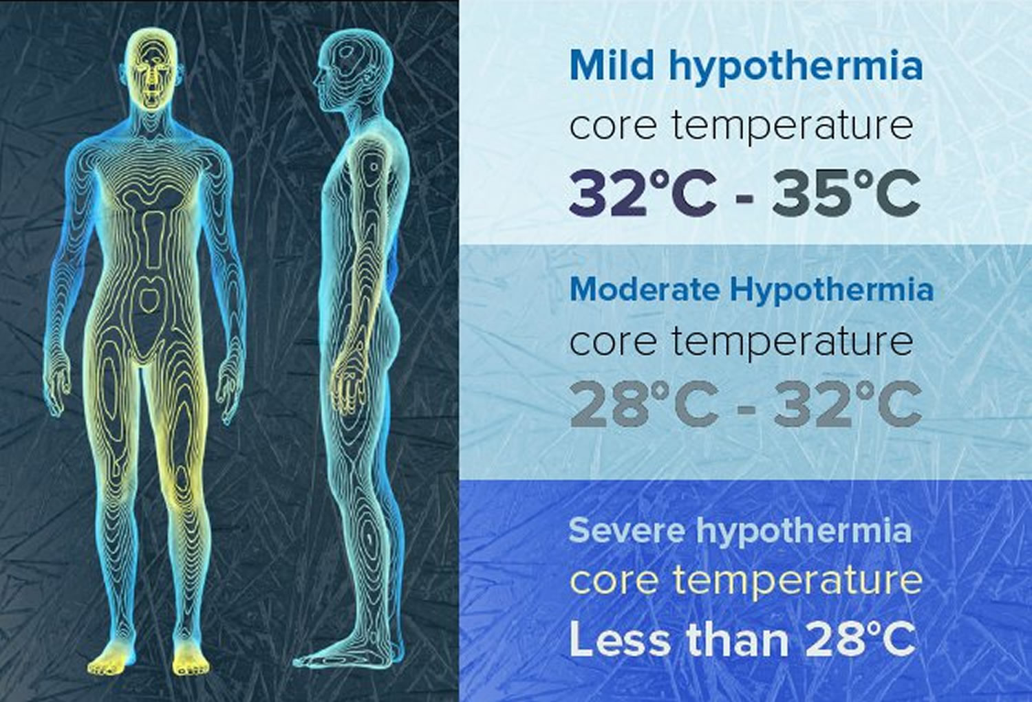 Hypothermia - Causes, Signs, Symptoms, Stages, Treatment