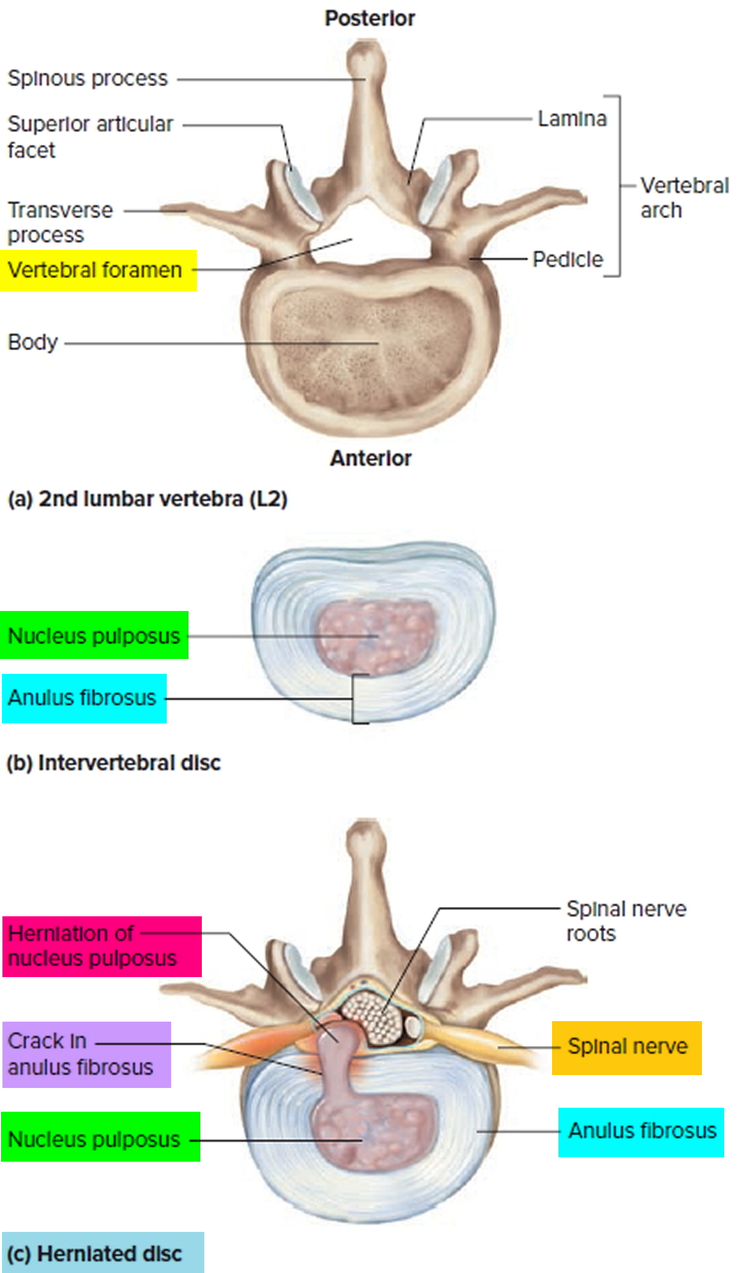 Vertebral Disc Herniation