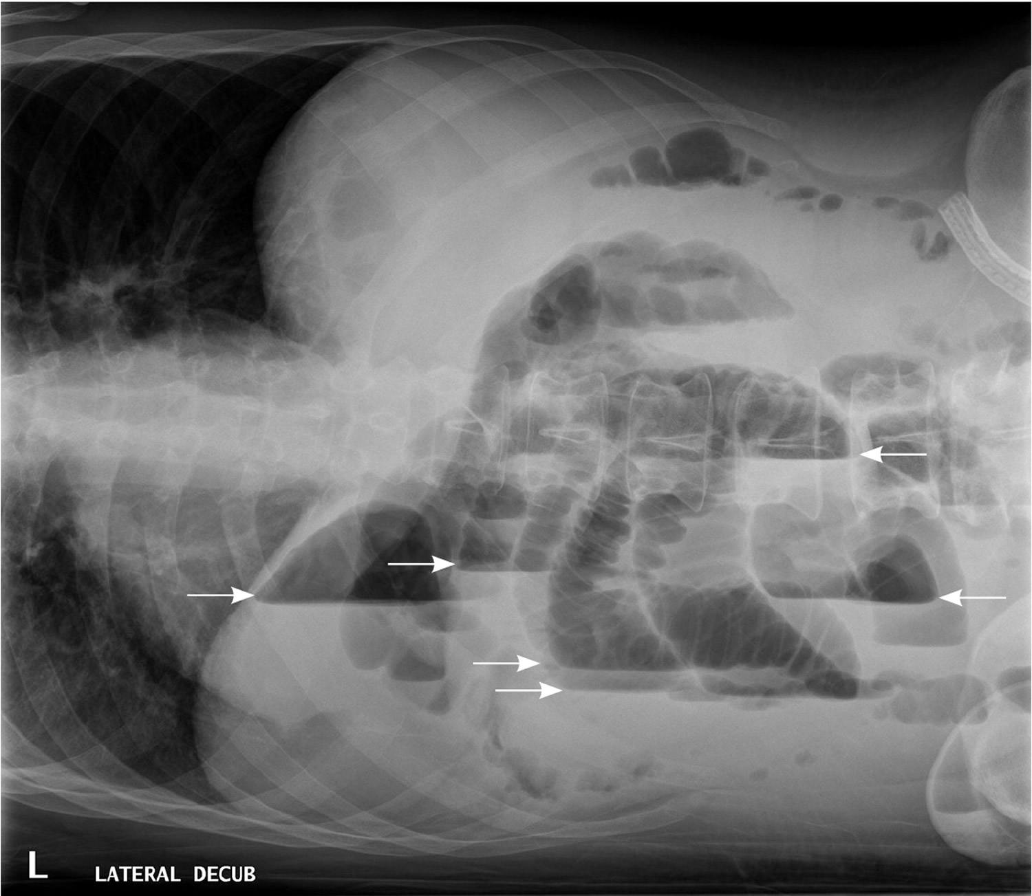 Bowel Obstruction - Small & Large - Causes, Symptoms, Treatment