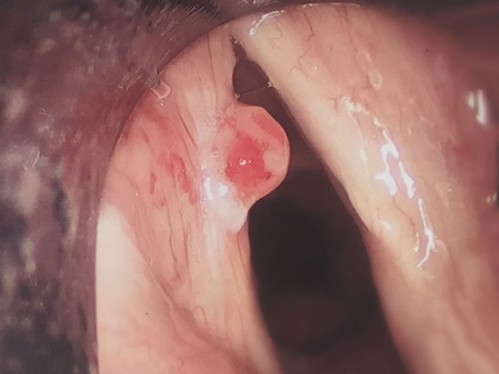 Throat Cancer - Causes, Signs, Symptoms, Survival Rate & Treatment