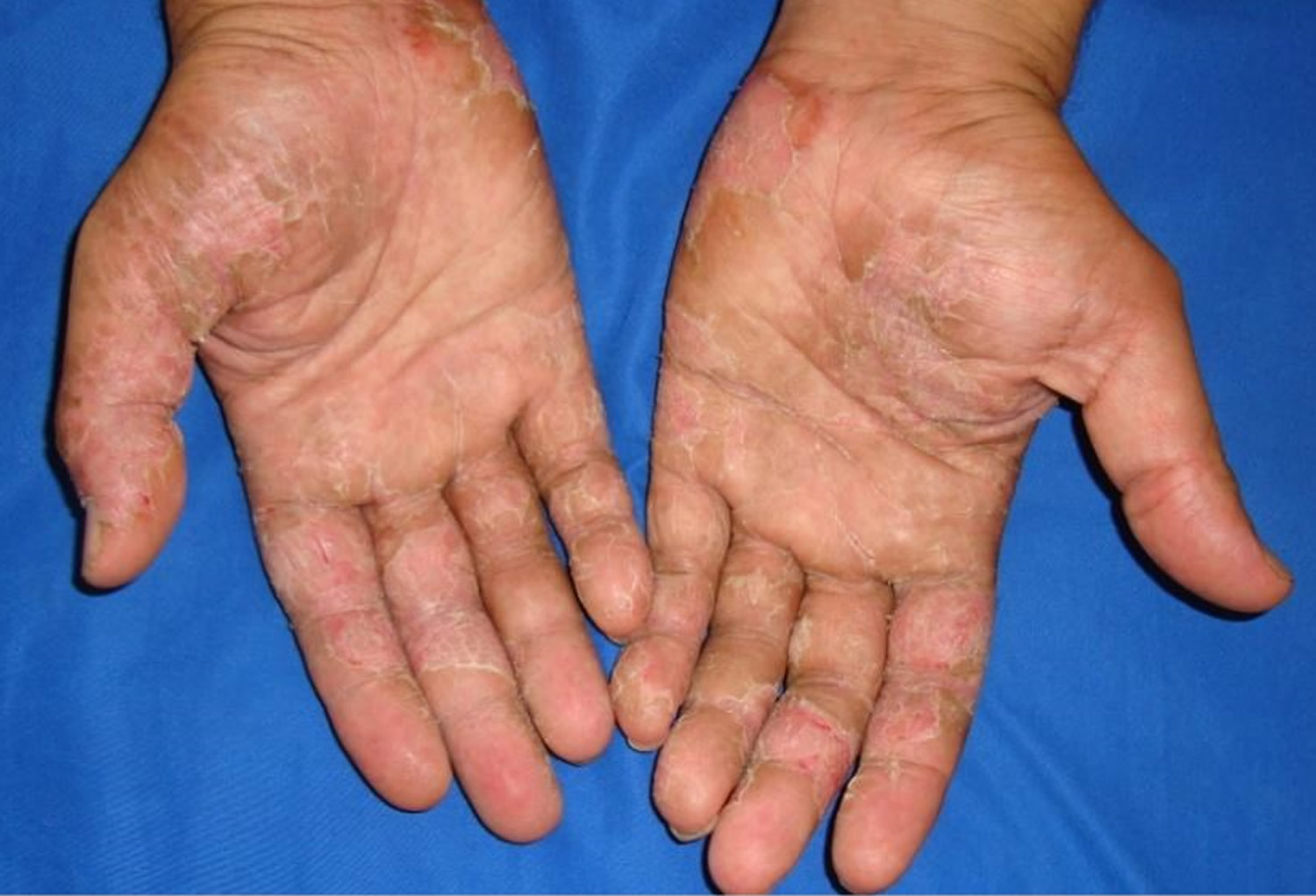 latex-allergy-symptoms-foods-latex-allergy-rash-treatment