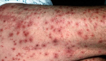 leukocytoclastic vasculitis