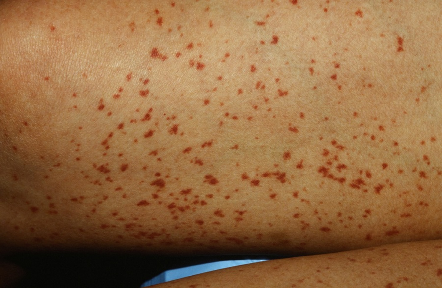 pinpoint red dots on skin lupus