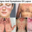 lupus-disease