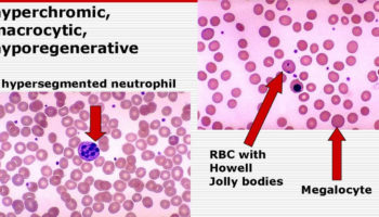 macrocytic anemia