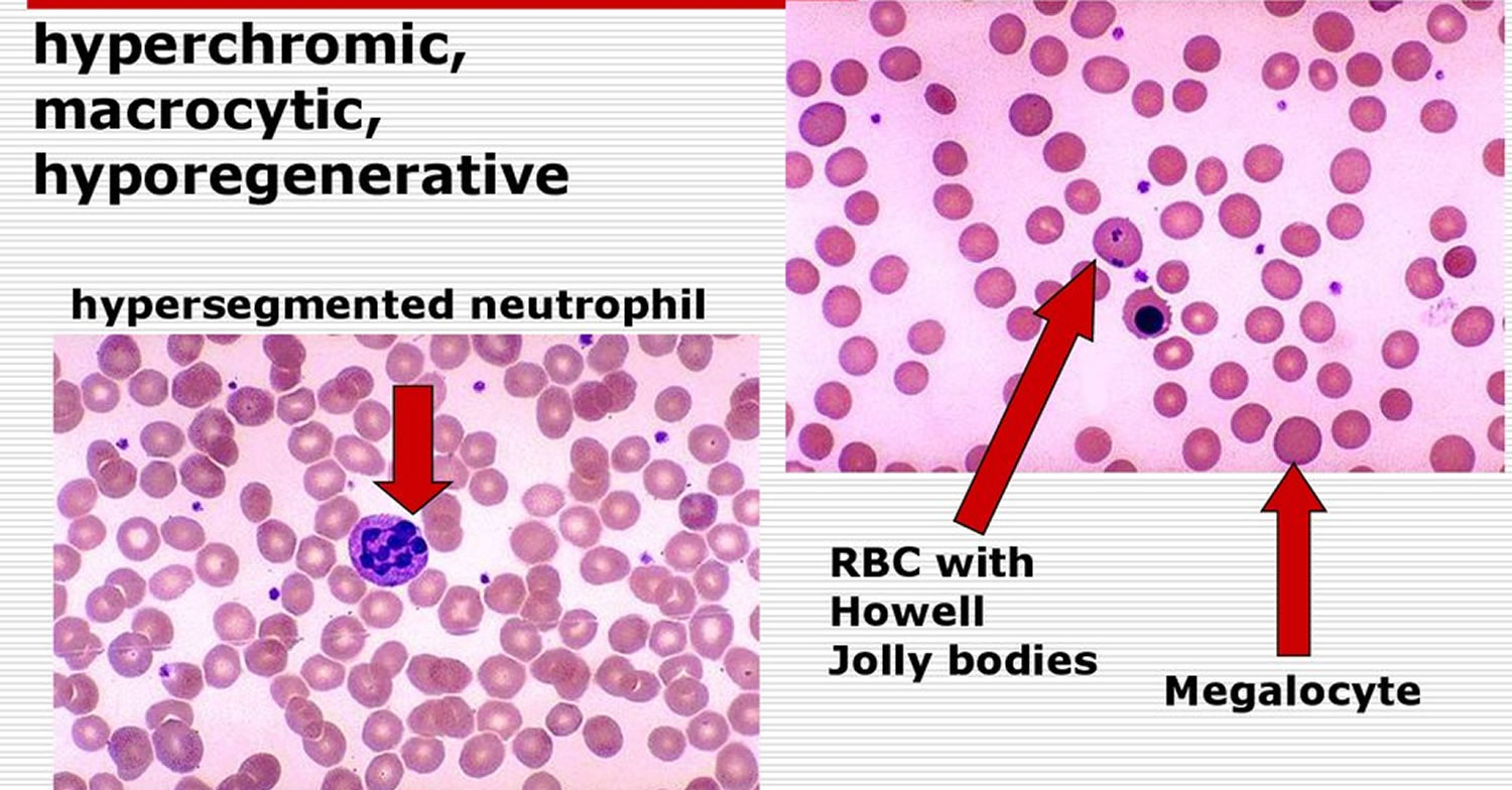 What Vitamin Deficiency Is Macrocytic Anemia