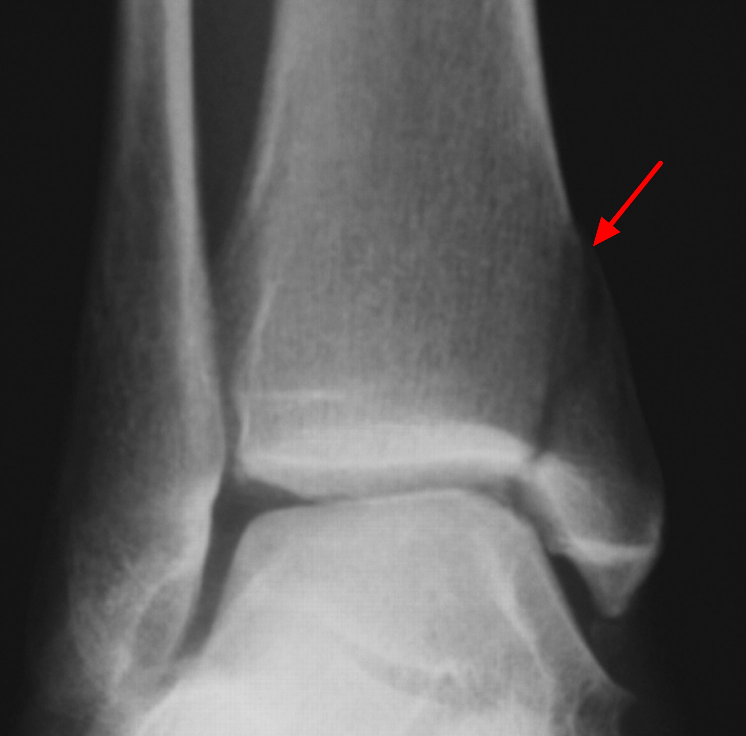 lateral malleolus fracture x ray