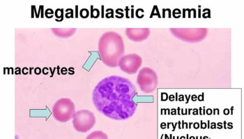 megaloblastic anemia