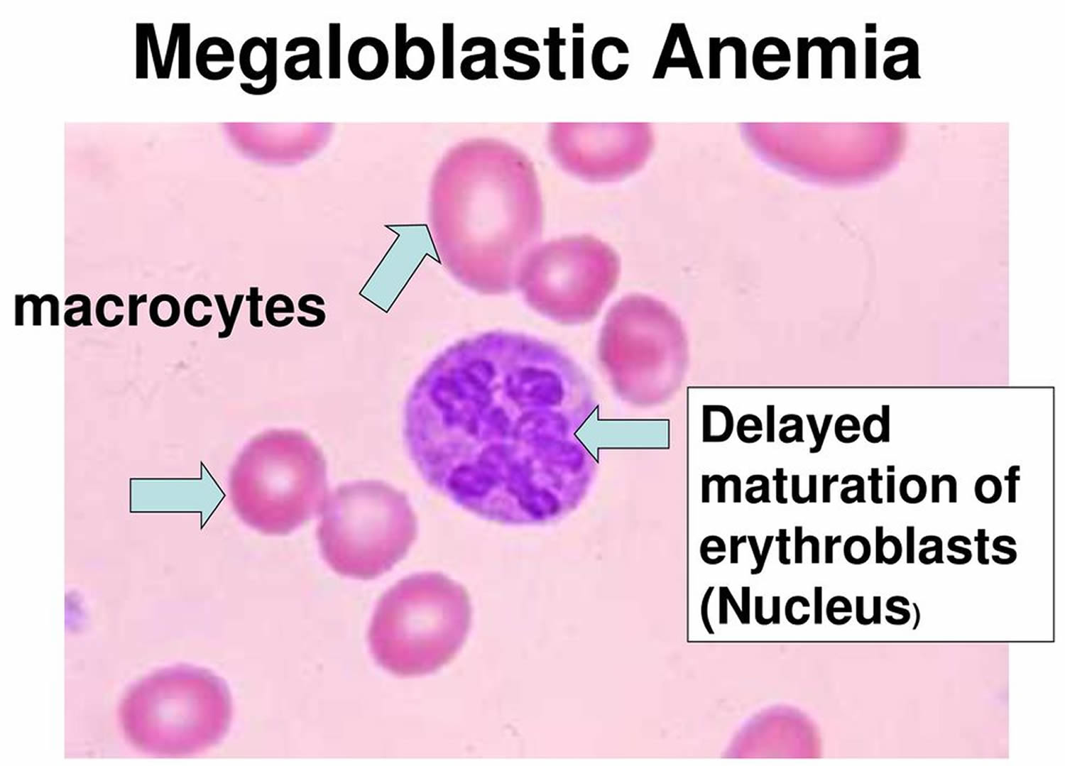 How To Say Megaloblastic Anemia