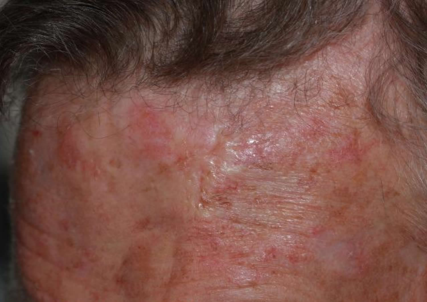 Basal Cell Carcinoma - Causes, Types, Symptoms, Prognosis, Treatment