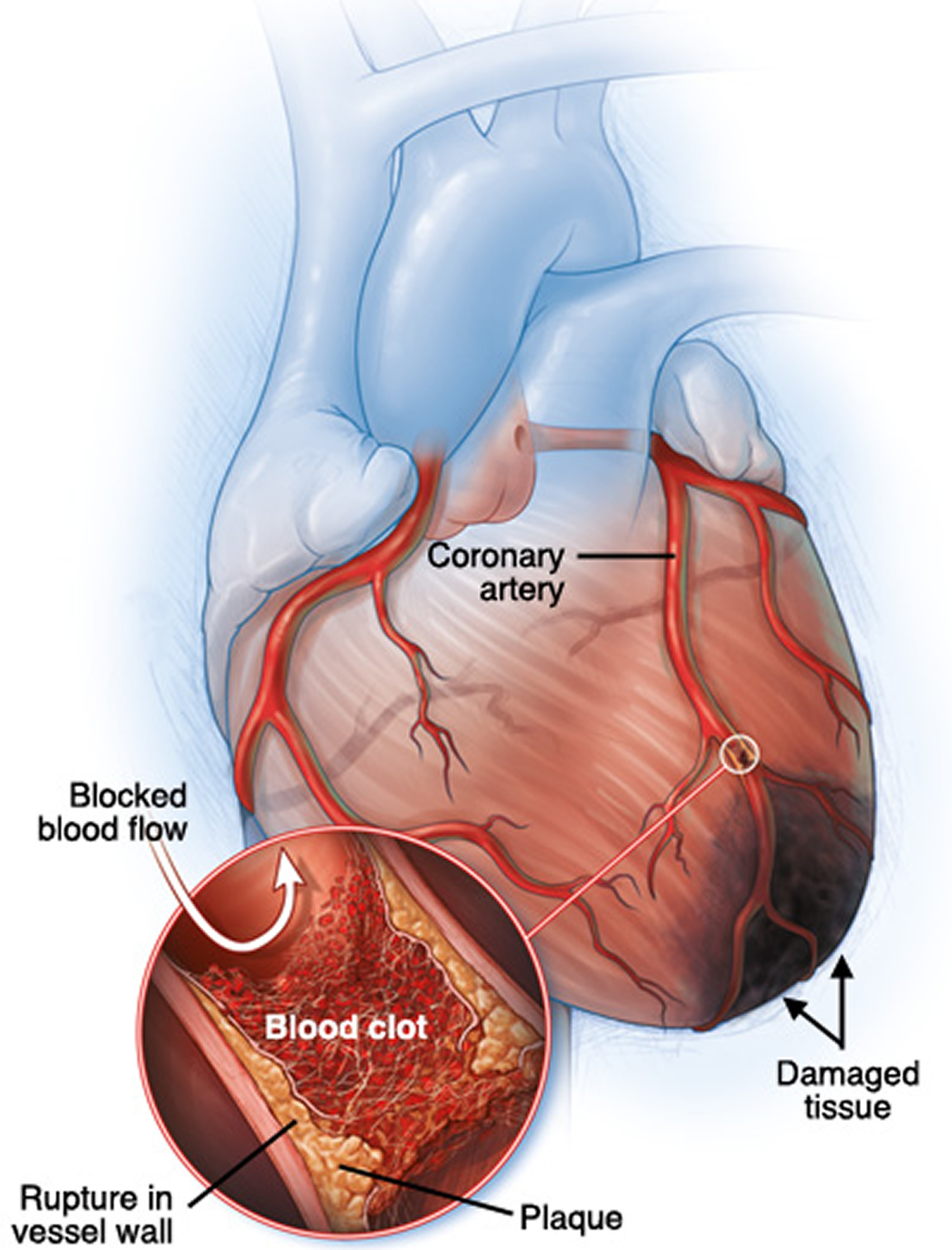 What Is An Infarction Of The Heart