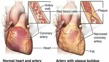 myocardial ischemia
