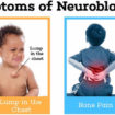 neuroblastoma